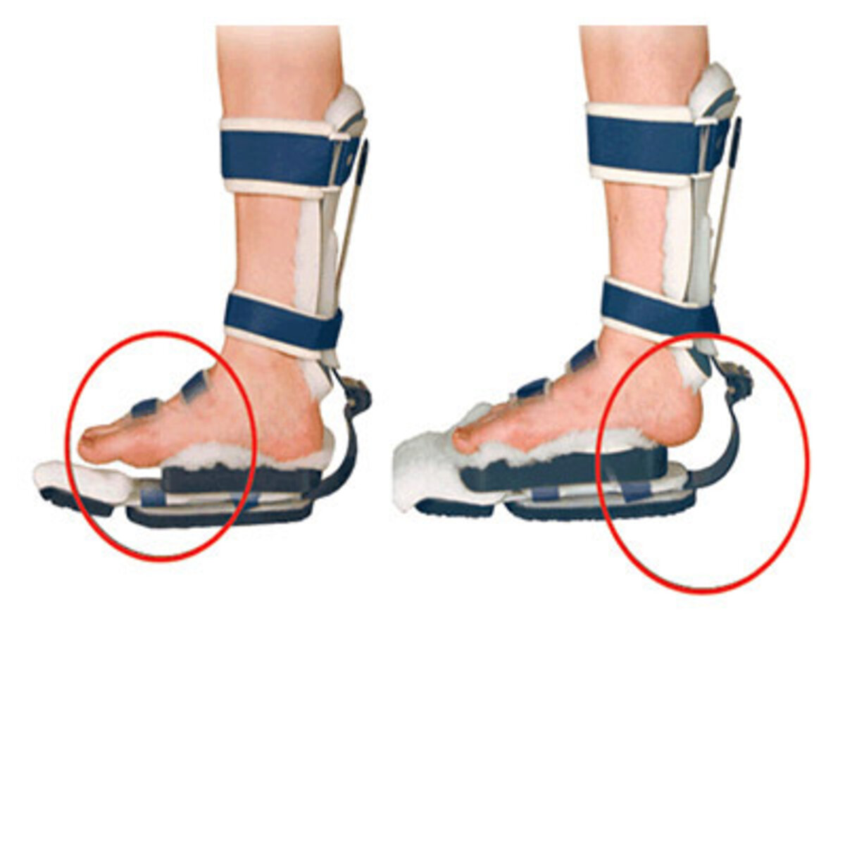 Plantar Surface Suspension (PSS™)